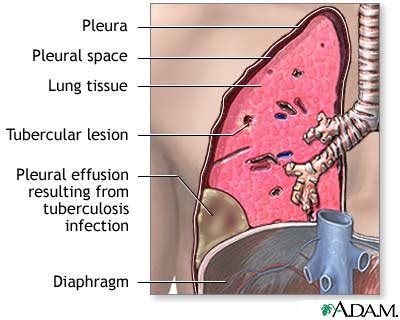 ithoxs pleural effusion