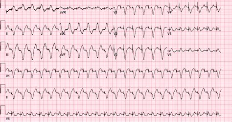 cureus pacemaker mediated tachycardia  case report
