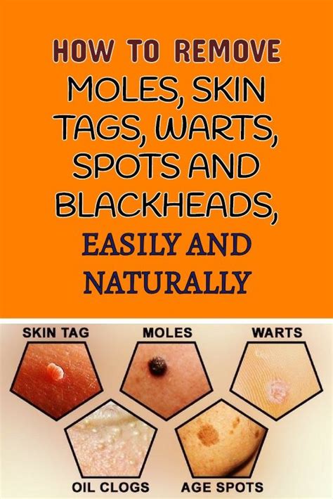 how to remove moles skin tags warts spots and