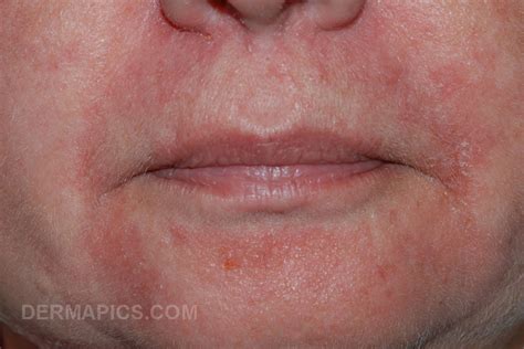 rash  mouth  chin pictures