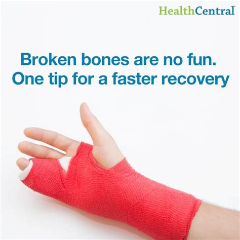 28 best casts and broken bones images on pinterest bones heal broken bones and x rays