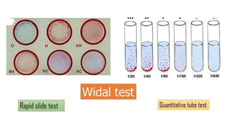widal test introduction procedure result interpretation  limitations