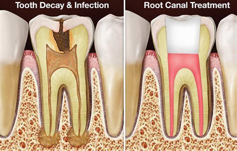 root canals devoted dentistry