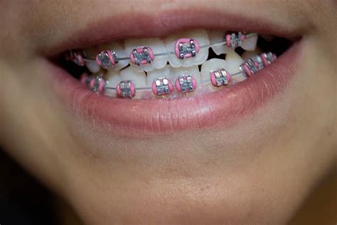 brackets  invisalign clinica dental maria gomez