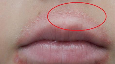 What Does An Allergic Reaction On Lips Look Like