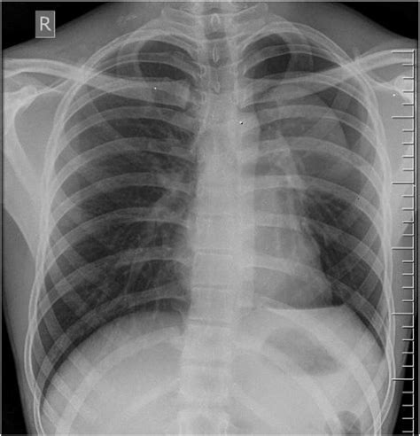 Chest Radiography With Left Lung Collapsed And Slight Mediastinal Shift