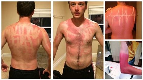 16 Horribly Hilarious Sunburns That Will Make You Want To