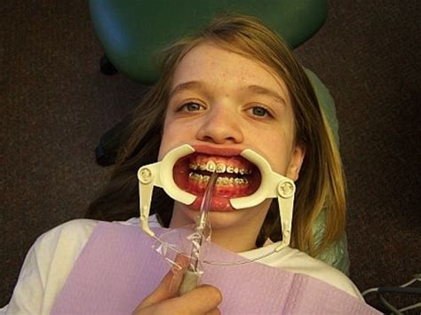 11 problems braces gave you that you re now thankful for in college
