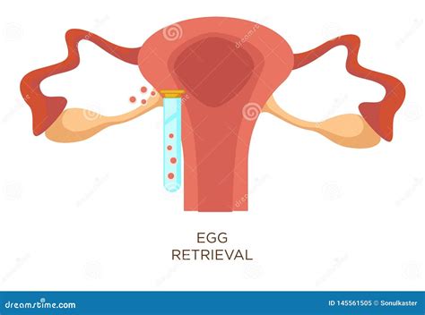 Egg Retrieval Stage In Vitro Fertilization Artificial Insemination
