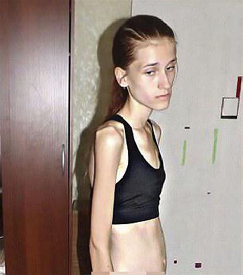 Teen Who Suffered From Severe Anorexia Turned Her Life Around