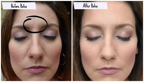 lift eyebrows  botox  simple guide  enhancing