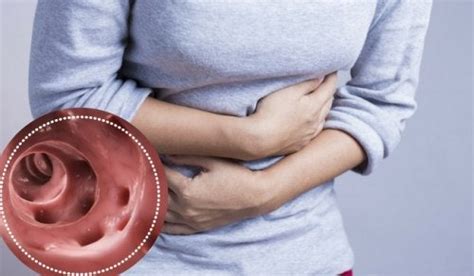 How To Fight Diverticulitis Naturally Step To Health