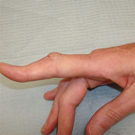 review  traumatic boutonniere deformity sports medicine review