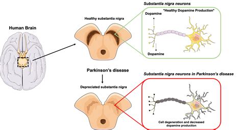 Parkinson S Disease Dopaminergic Neurons Captions Update Trendy