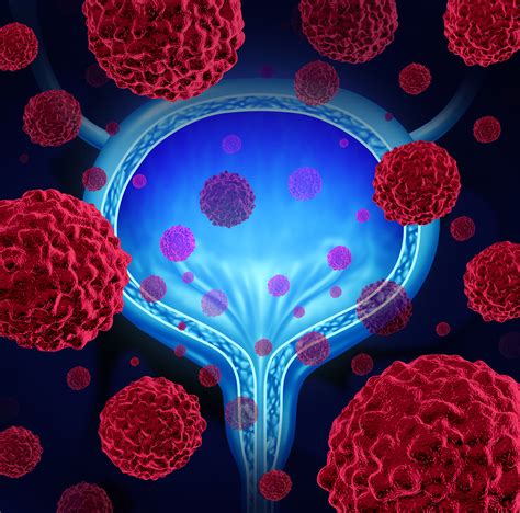 harnessing your immune system to treat advanced bladder