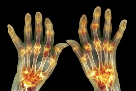 arthritis   fingers