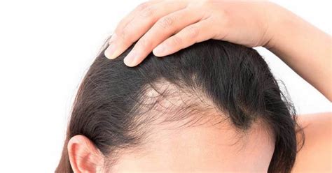 Essendo la calvizie femminile morfologicamente diversa da quella maschile e per rispondere alle diverse esigenze estetiche, per le donne si realizza un . Caduta di capelli anomala a ciocche o chiazze? Lâalopecia ai tempi del