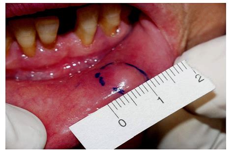 dentistry  medicine notes  mucocele  mucous retention cyst