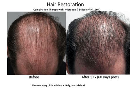 prp hair restoration ei con health and wellness center