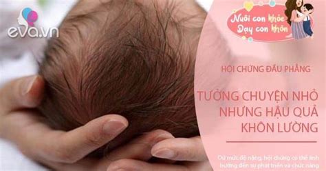 Hội Chứng đầu Phẳng ở Trẻ Sơ Sinh 3 Việc Mẹ Cần Làm Sớm để Tránh Hậu Họa