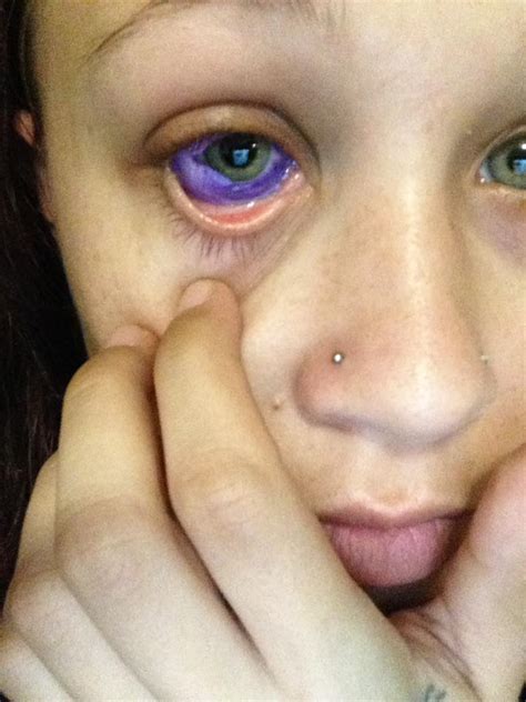this woman got a tattoo on her eyeball and it went horribly wrong her ie
