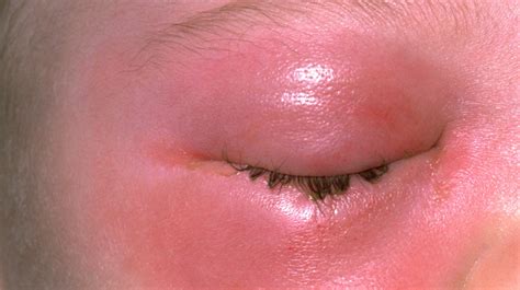 rash  eyes symptoms  treatment
