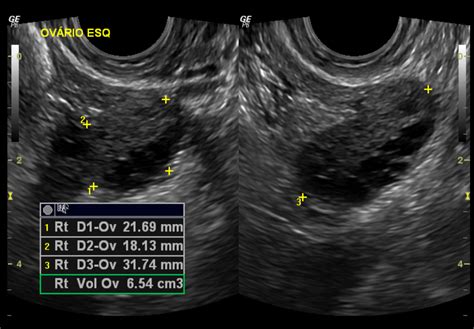 Normal Pelvic Ultrasound Transvaginal Image
