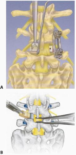 Transforaminal And Posterior Lumbar Interbody Fusion