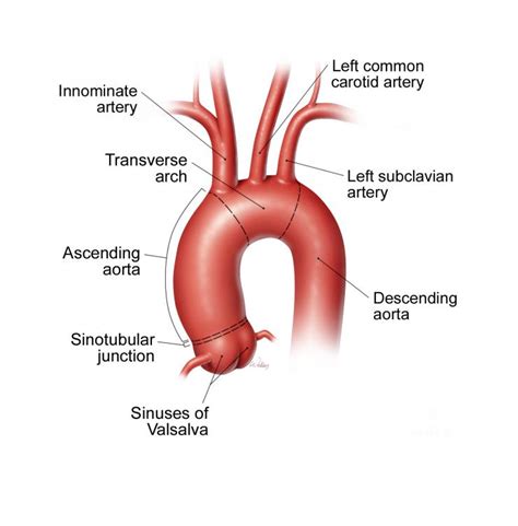 descending  thoracoabdominal aortic aneurysms  dissections