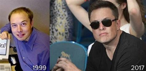 Elon Musk Before And After His Hair Transplant Photo