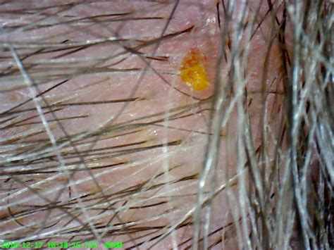 morgellons disease awareness morgellons hair