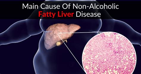 Main Cause Of Non Alcoholic Fatty Liver Disease Nafld Dr Sam Robbins
