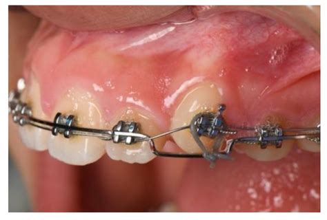 jcm  full text clinical considerations  orthodontically