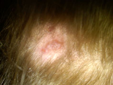 scabs  head pictures