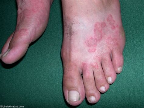 fungal infections   skin podiatry hq