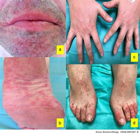 atypical vesicular bullous hand foot mouth disease in 2 adults actas