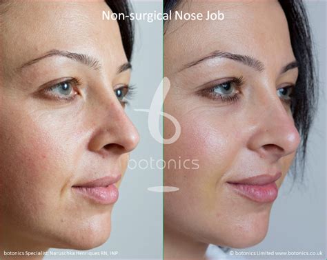 non surgical nose job before and after pictures botonics