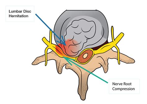 lumbar disc herniation  sciatica dr yu chao lee