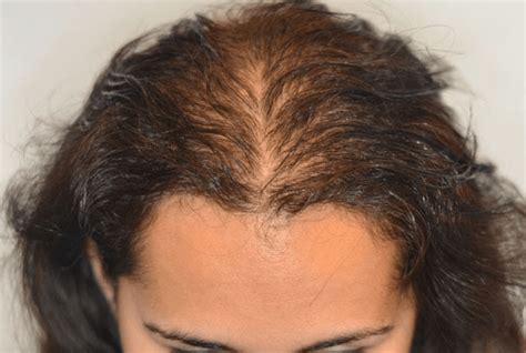 scalp micropigmentation  women san antonio lavender falls face