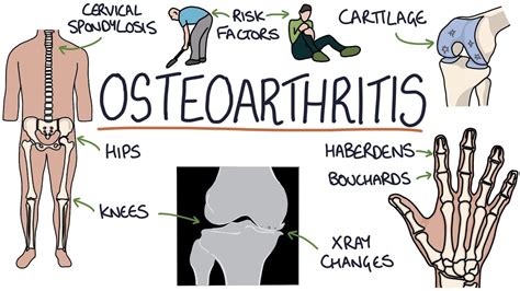 osteoarthritis visual explanation  students