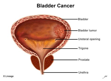 bladder cancer oncology medbullets step
