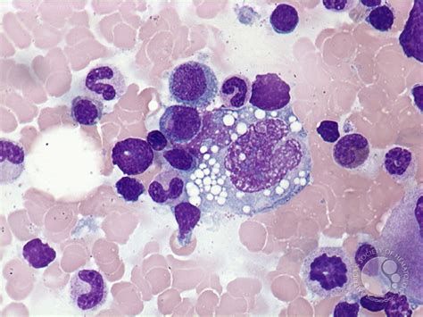 anaplastic large cell lymphoma bone marrow aspirate
