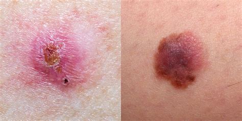 skin cancer pictures 5 different types of skin cancer to