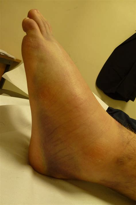 ankle sprain  sprained ankle hertfordshire uk