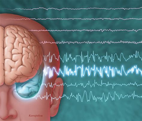 early seizures  traumatic brain injury tied  poor outcomes