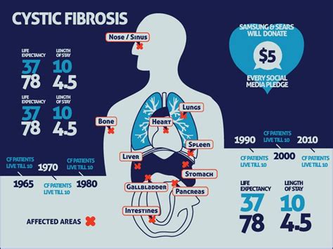 cf infographic cystic fibrosis cystic fibrosis awareness cystic