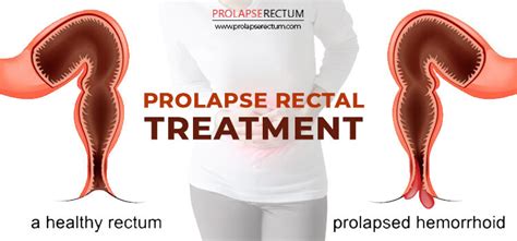 causes of rectal prolapse