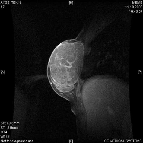 sagittal t2 weighted image shows a large hyperintense well marginated