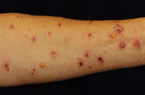 risk factor  drug induced skin disease identified hokkaido