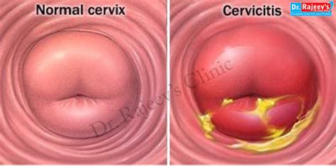 homeopathy treatment for cervicitis